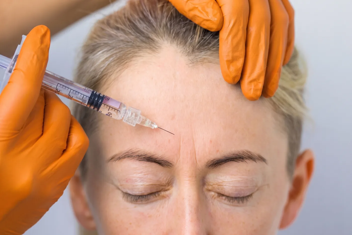 Botox-Injektion an der Stirn gegen Zornesfalte und Stirnfalten in Würzburg bei Dr. Sabine Hugo
