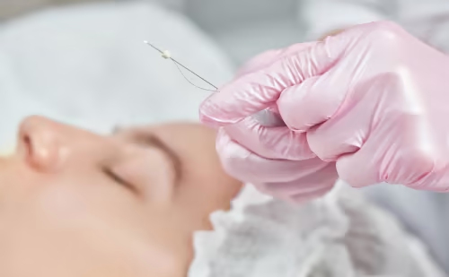 Fadenlifting – Gesichtskontur