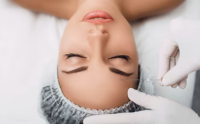 Diskretes Fadenlifting