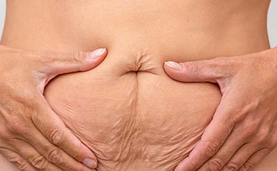 HiFu Behandlung – Bauch