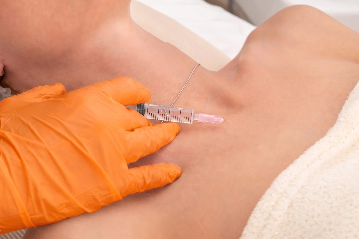 Lachssperma-Behandlung am Dekolleté: Polynukleotide-Injektion in der Praxis Ästhetik in Mainfranken