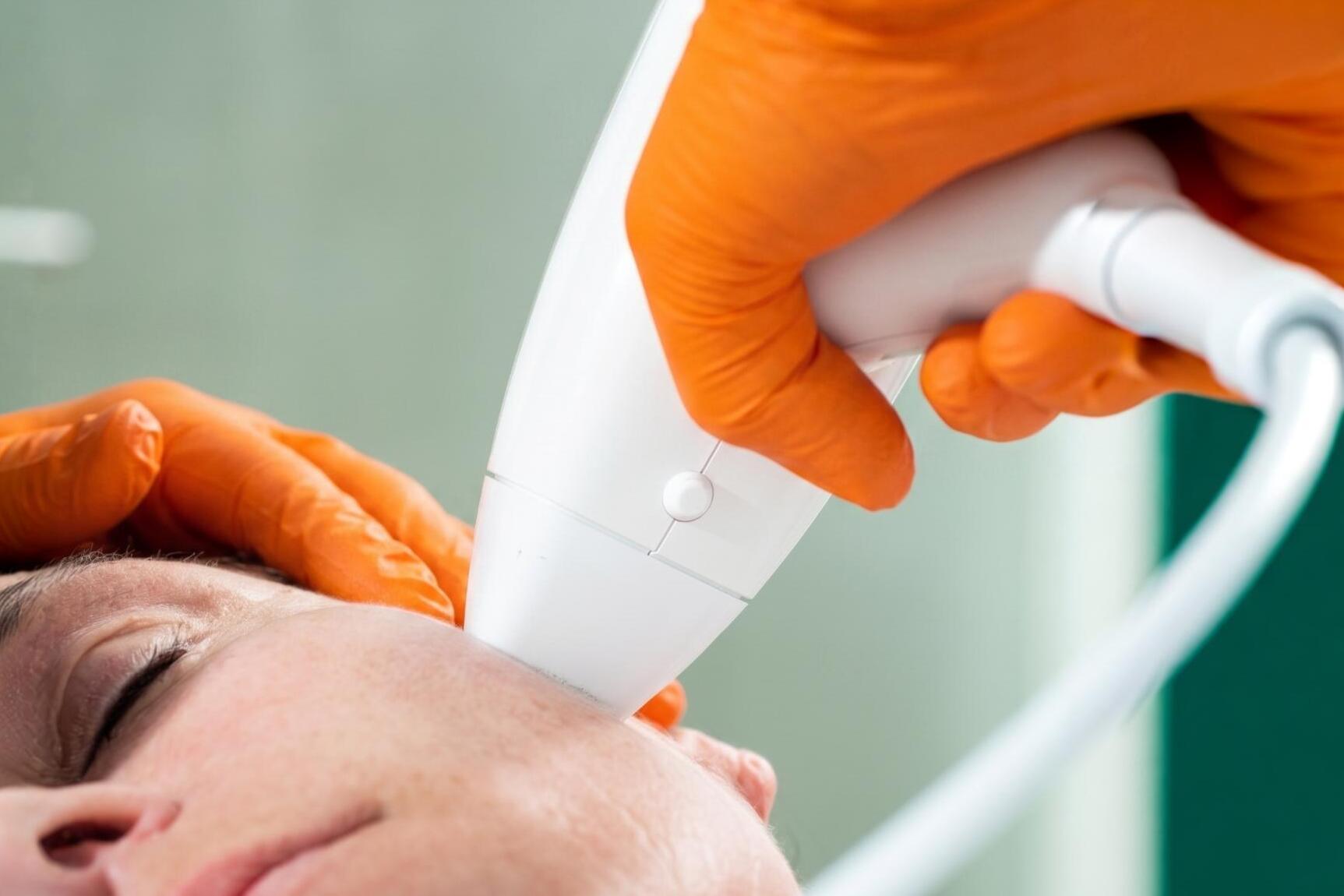 Venus Viva MD Skin Resurfacing an der Stirn in der Praxis Dr. Hugo